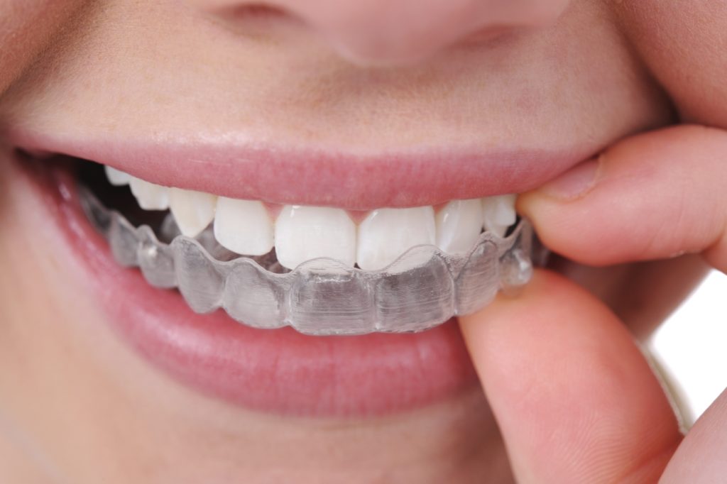 Close-up of a patient pressing a clear aligner tray onto their upper teeth
