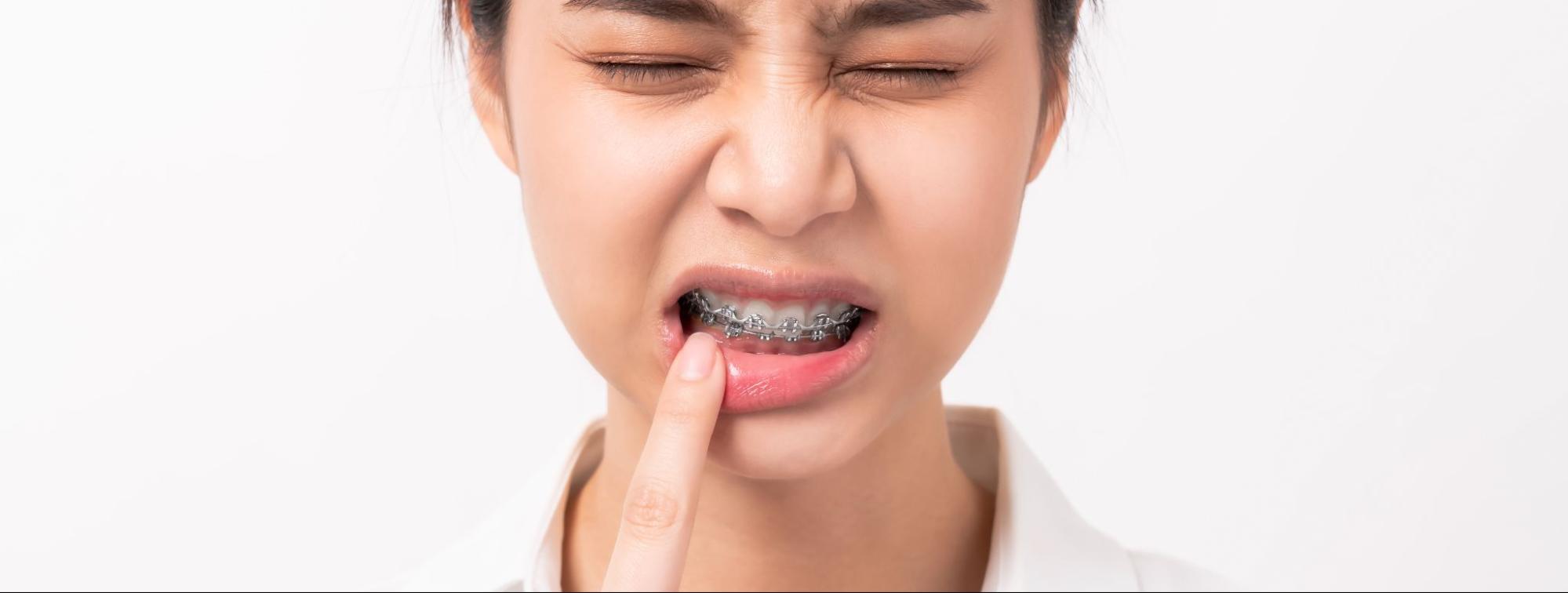 What To Do When Braces Break?
